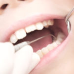 虫歯治療・無痛治療